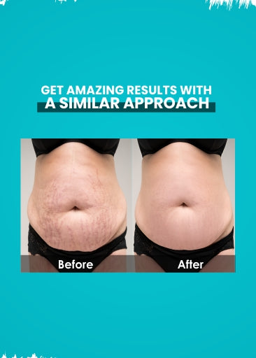 Stretch Mark Removal Oil